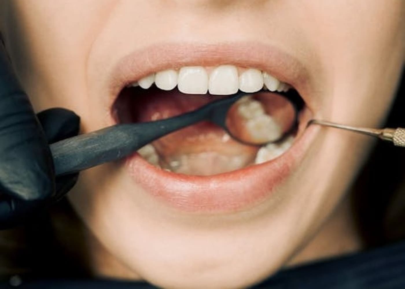 Painful Gum Flares and Unexpected Mouth Spots: What They Mean